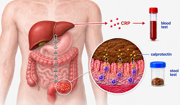 Diagram showing CRP from the liver measured in a blood test and calprotectin from inflamed bowel lining measured in a stool test.