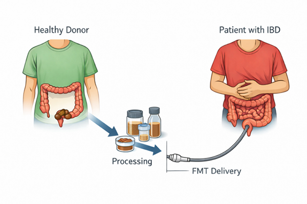 Fecal microbiota transplant process in Crohn’s disease and ulcerative colitis showing healthy donor stool processing and colonoscopic delivery into patient with IBD