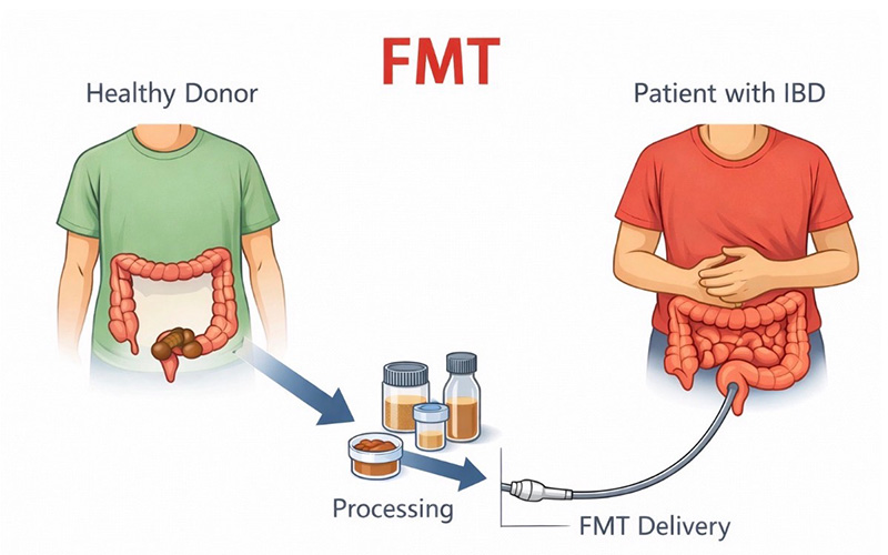 FMT explanation showing healthy donor microbiome processing and delivery to a patient with IBD