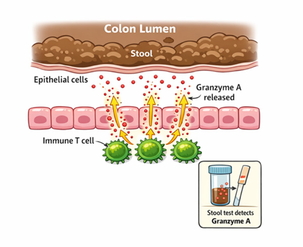 Granzyme A stool test mechanism in Crohn’s disease and ulcerative colitis